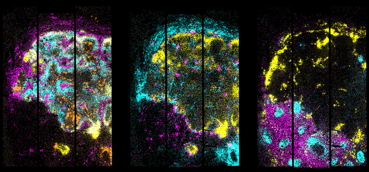 2D map of gene expression in the metastatic lymph node