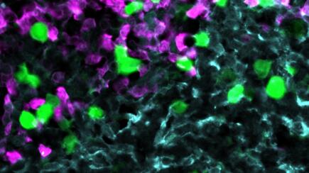 Die gegen CXCR5 gerichteten CAR-T-Zellen (grün) greifen Lymphom-Zellen (rot) innerhalb des Stroma-Zellnetzwerks im B-Zell-Follikel an (hellblau).