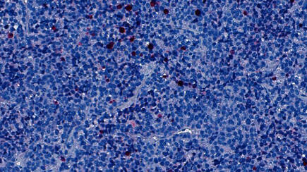 Tumorzellen eines Patienten mit Alveolarem Rhabdomyosarkom