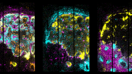 2D map of gene expression in the metastatic lymph node